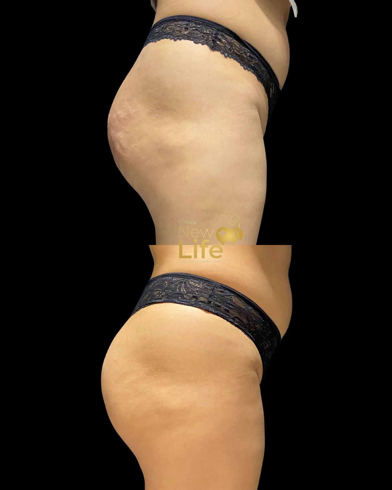 Antes e depois — paciente New Life