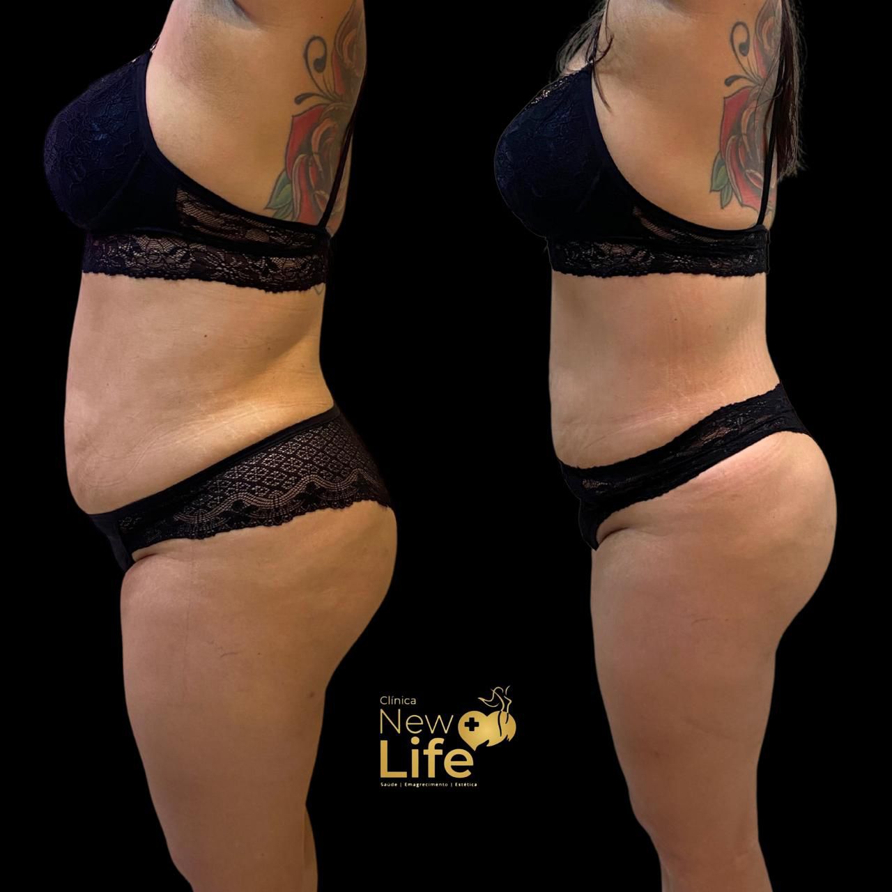 Antes e depois — paciente New Life