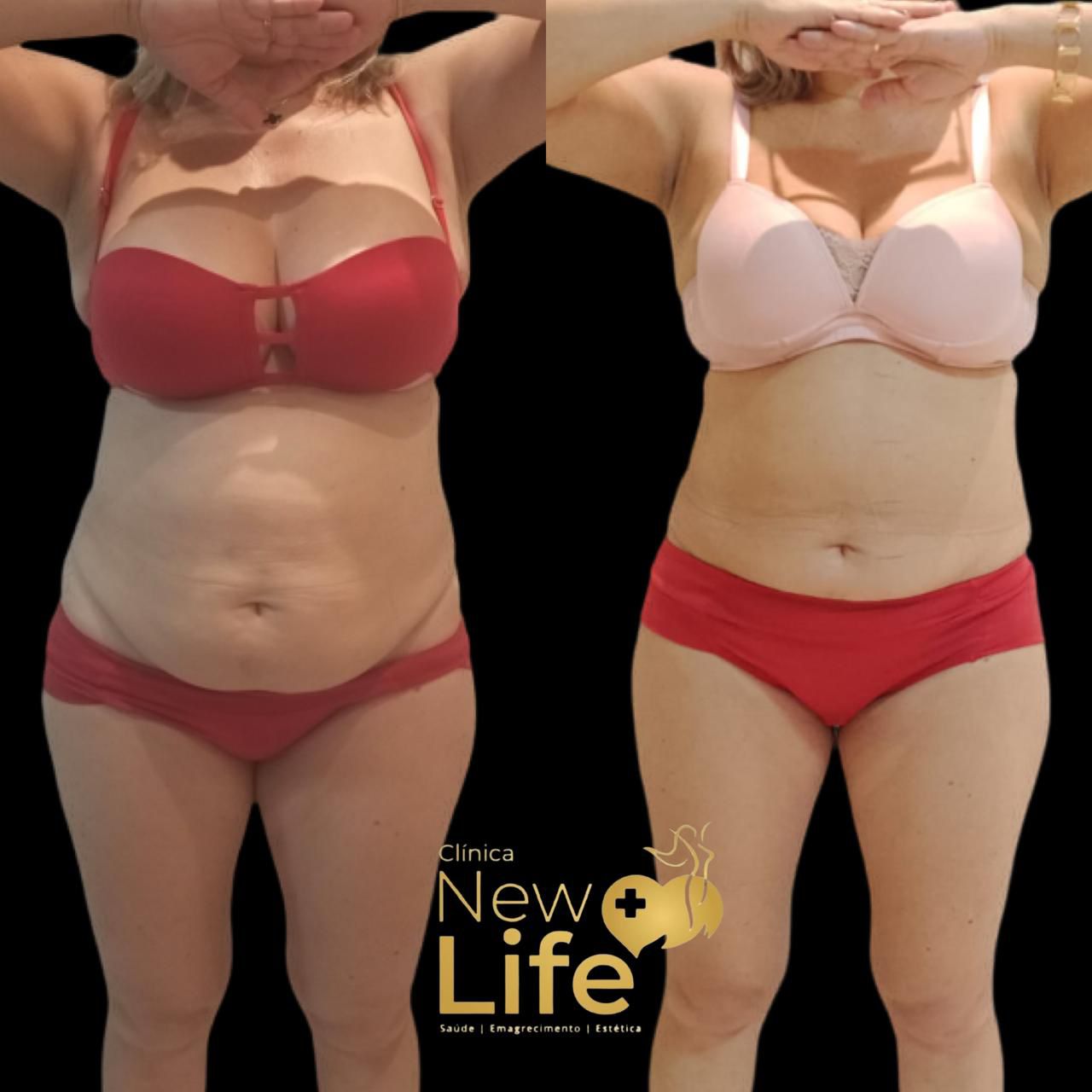 Antes e depois — paciente New Life